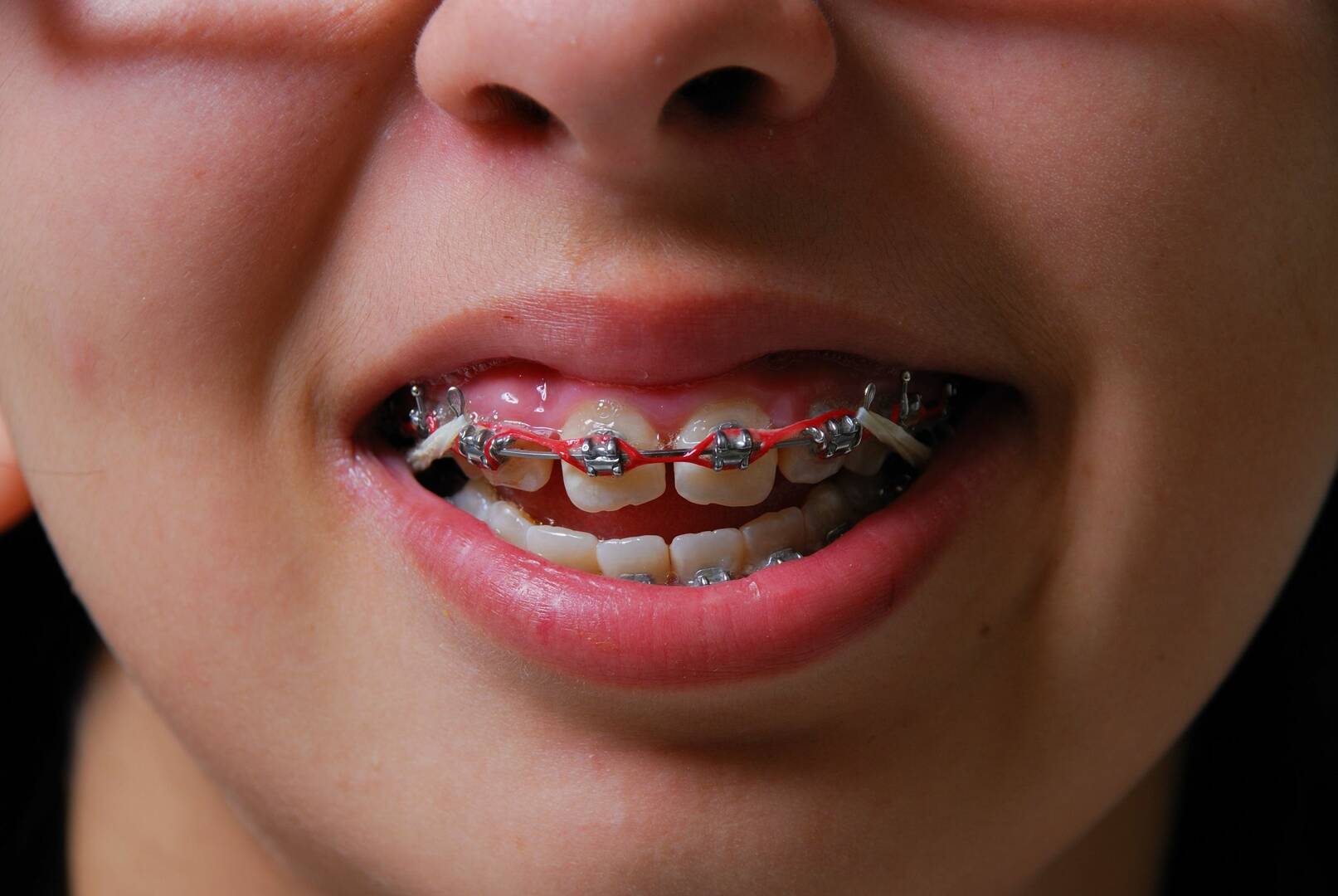 Katz Orthodontics: Mark J. Katz, DDS,MSD, PA